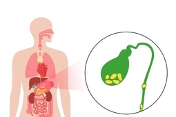 [건강상식] 다이어트 주사로 급격한 체중 감량…'담석증' 위험 높일 수 있어