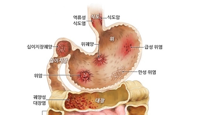 (사진=네이버 두산백과 역류성식도염 사진 캡처)