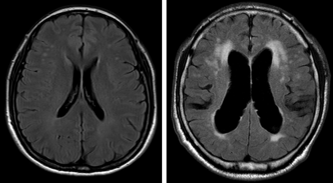 정상 뇌(사진 왼쪽)와 정상압 수두증 환자의 뇌 MRI 비교 영상. 정상 뇌에 비해 오른쪽 정상압 수두증 환자에서는 과다 축적된 뇌척수액으로 인해 뇌실이 확장되어 있는 것을 확인할 수 있다. (사진=분당서울대병원 제공)
