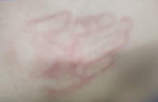  지적장애 아동 B 씨 등에 남은 폭행 흔적. (사진=MBC뉴스 갈무리)