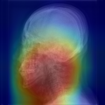 두경부 X-ray 영상을 활용한 수면무호흡증 진단 예시. 딥러닝 알고리즘이 수면무호흡증 여부를 분류하는 이미지 상 특이점의 위치(붉은색)를 확인할 수 있다. (사진=분당서울대병원 제공)