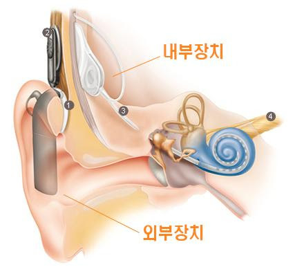 인공달팽이관 구조. ( 사진 = 코클리어사 공식 블로그 갈무리 )