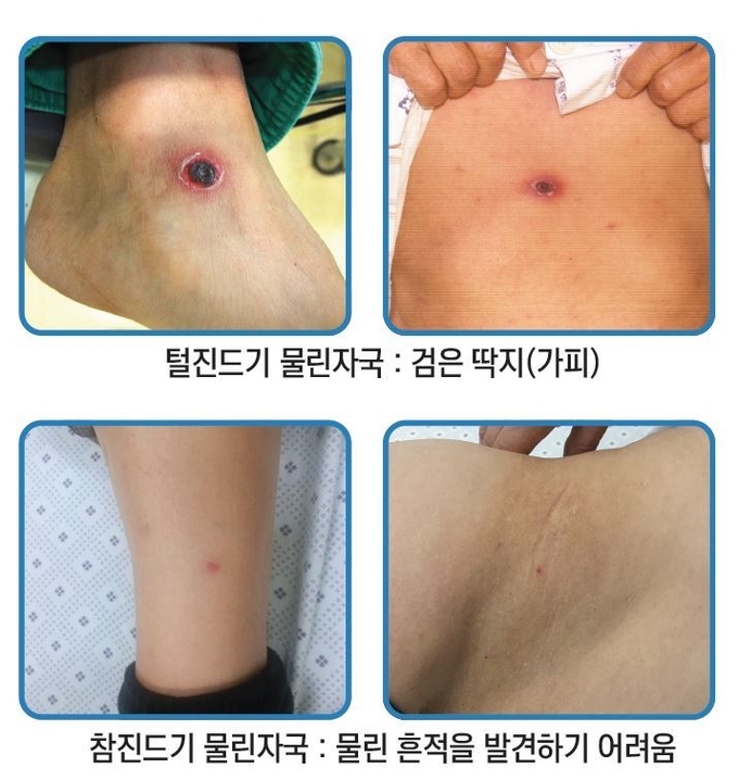 진드기 매개감염병 환자가 진드기에 물린 자국. ( 사진 = 옹진군 제공 )