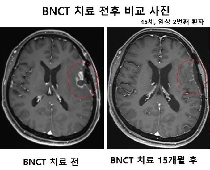 BNCT 치료 전후 비교 사진. ( 사진 = 가천대 길병원 제공 )