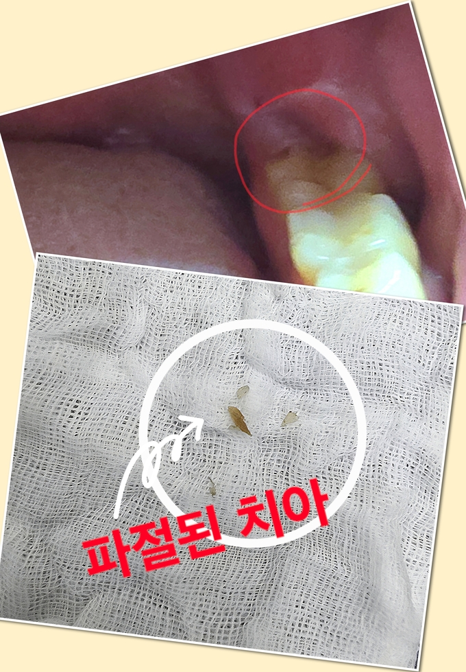 파절된 박희범 부국장 어금니. (사진=경기신문)