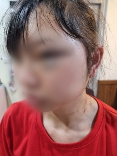  폭행 피해를 당한 이주노동자 B씨. (사진=연합뉴스)